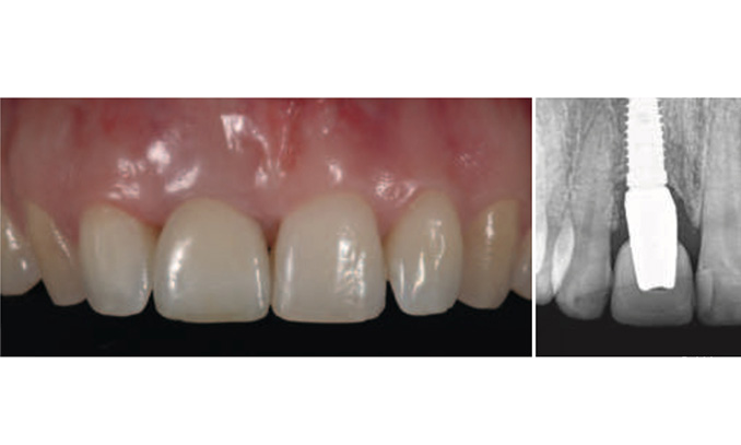 Buccal plate reconstruction with an intentionally exposed nonresorbable membrane: 1 year after loading results of a prospective study