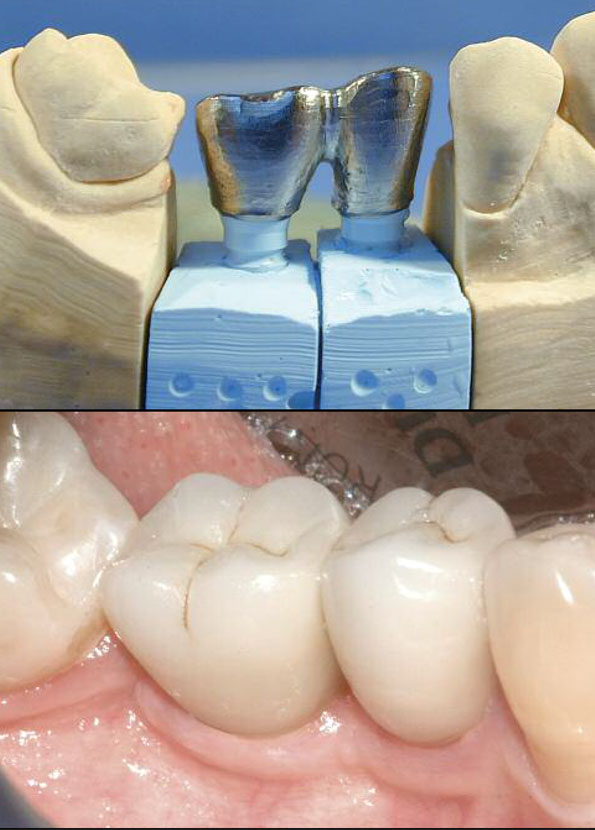 The Abutment Duplication Technique: A Novel Protocol for Cementable Implant-Supported Restorations