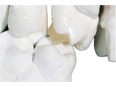 stratificazione-dentinale